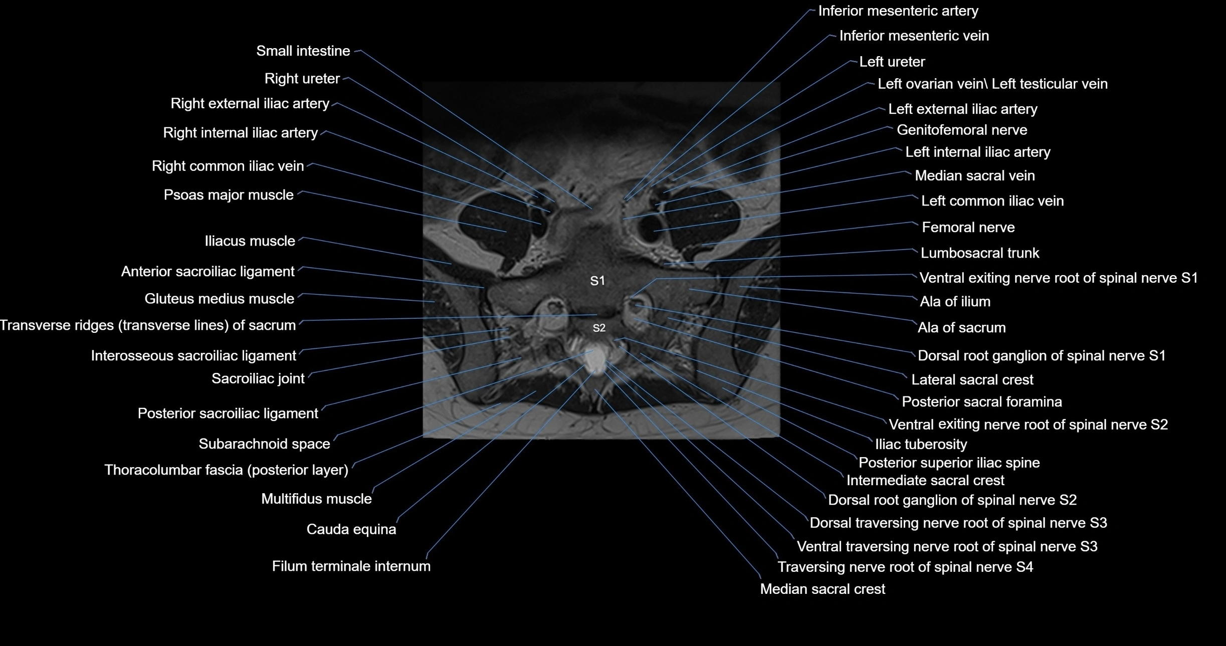 MRI lumbar spine axial cross sectional anatomy 3T radiology  image-img-00001-00046.webp